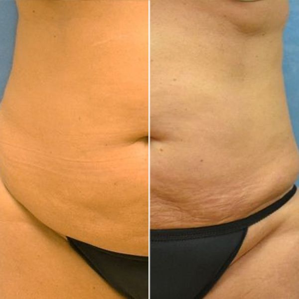 Before and after lipo