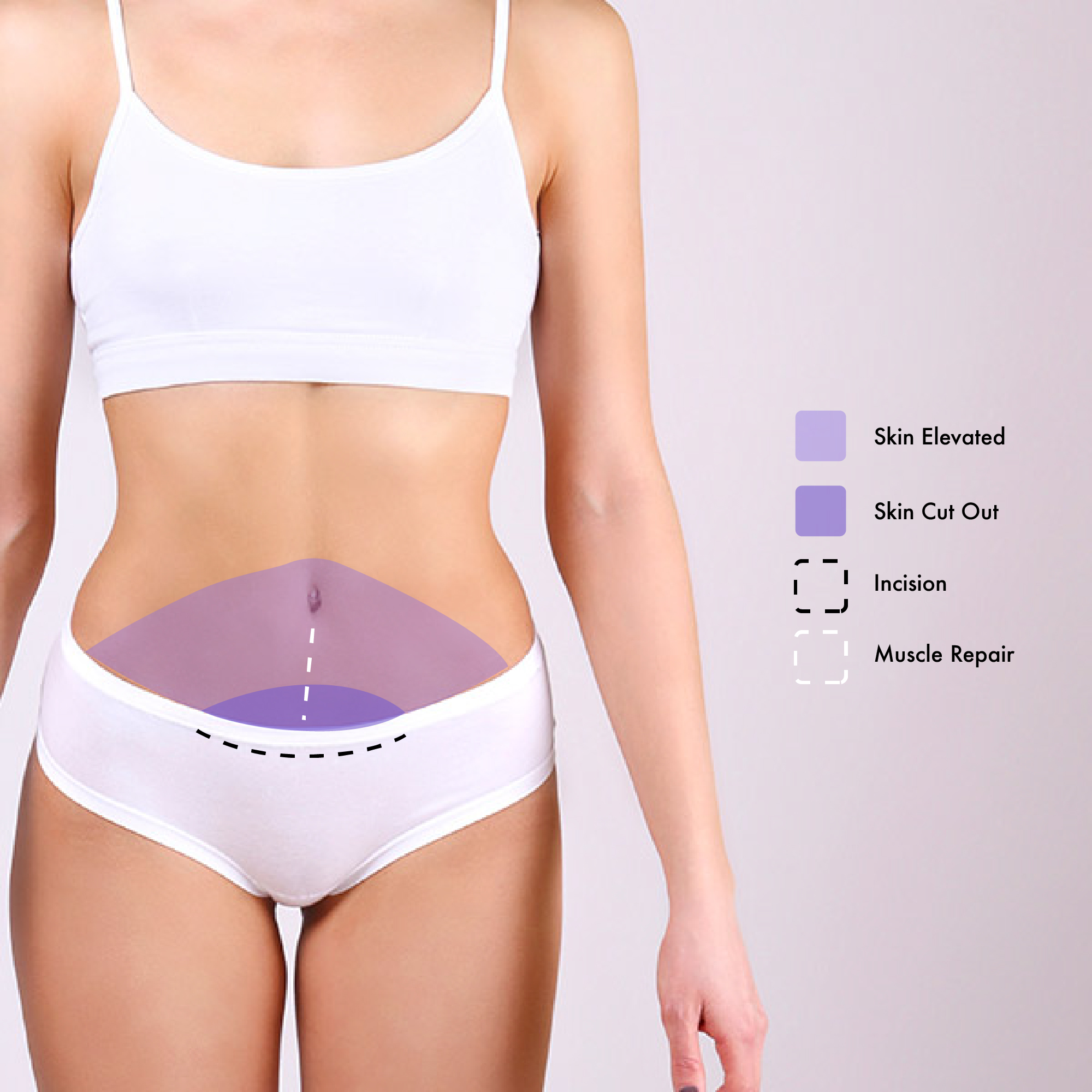 How Much Is A Mini Tummy Tuck?