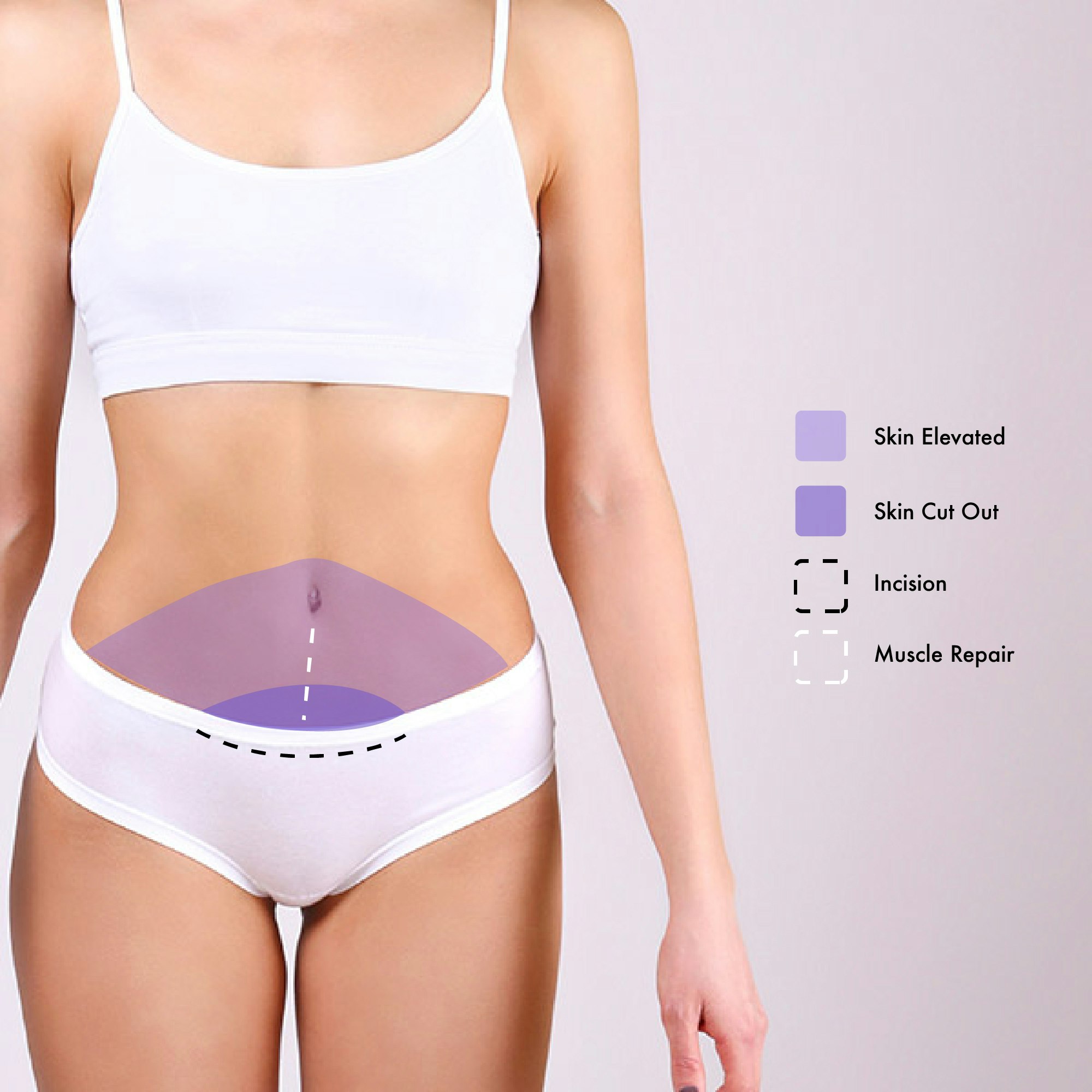 Mini tummy tuck diagram of where the abdomen skin is cut out and elevated as well as the muscle repair