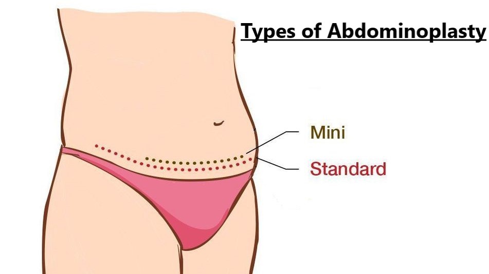 Understanding Mini- vs Full Tummy Tuck Surgery - Explore Plastic Surgery