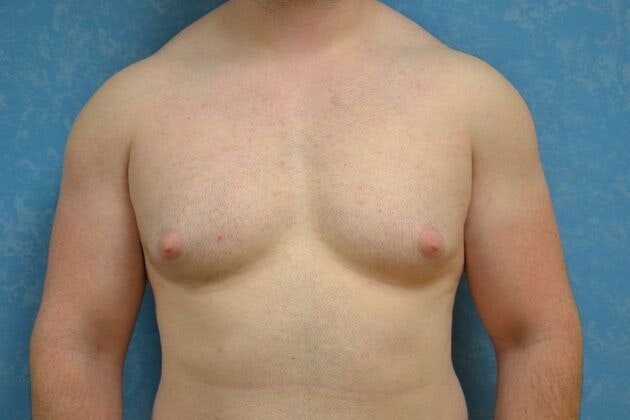 Before gynecomastia