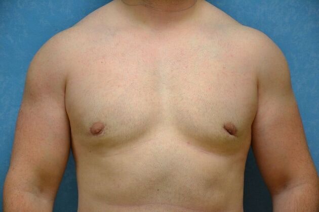 After gynecomastia
