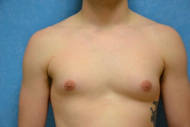 Before gynecomastia