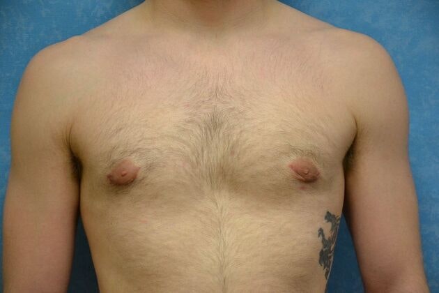 After gynecomastia