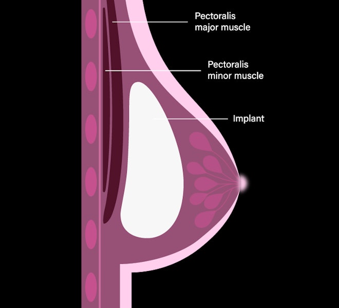 Subglandular