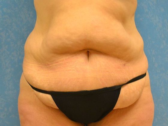 before tummy tuck