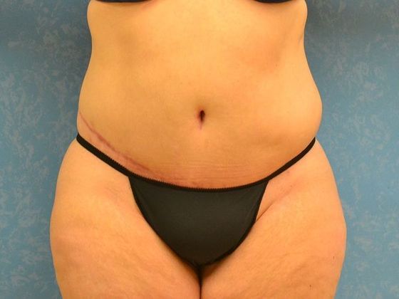 after tummy tuck