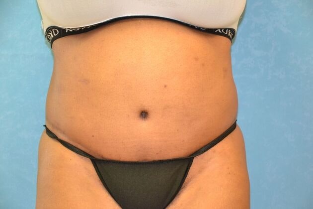 after tummy tuck in toledo