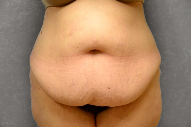 before tummy tuck