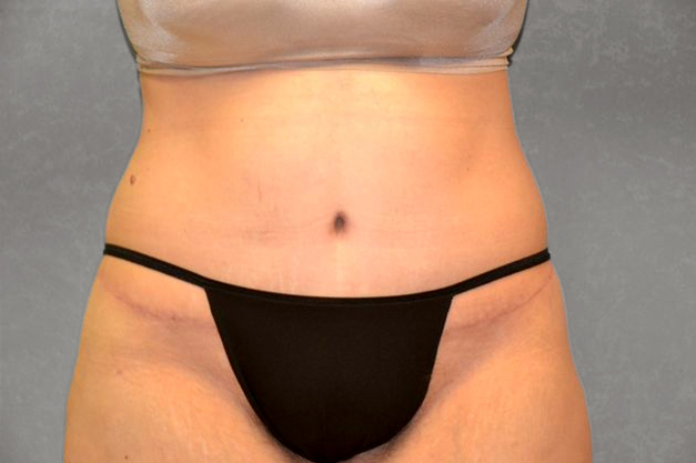 after tummy tuck