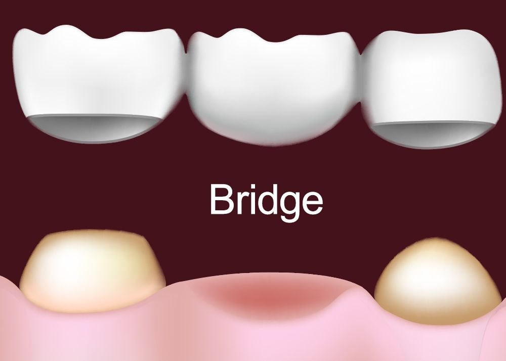 Dental Bridges