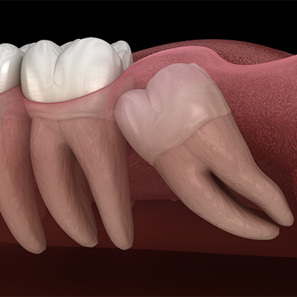 impacted wisdom tooth
