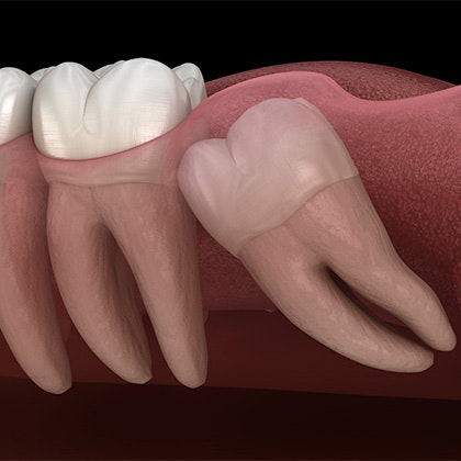 impacted wisdom tooth