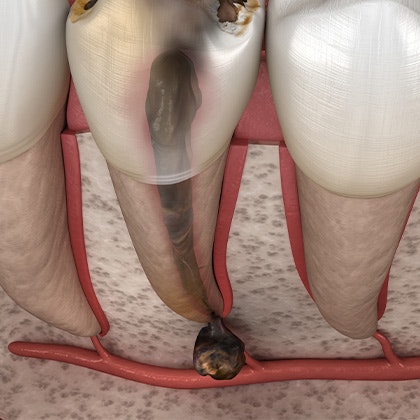 root canal infection
