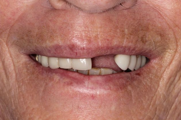 Smile with missing tooth