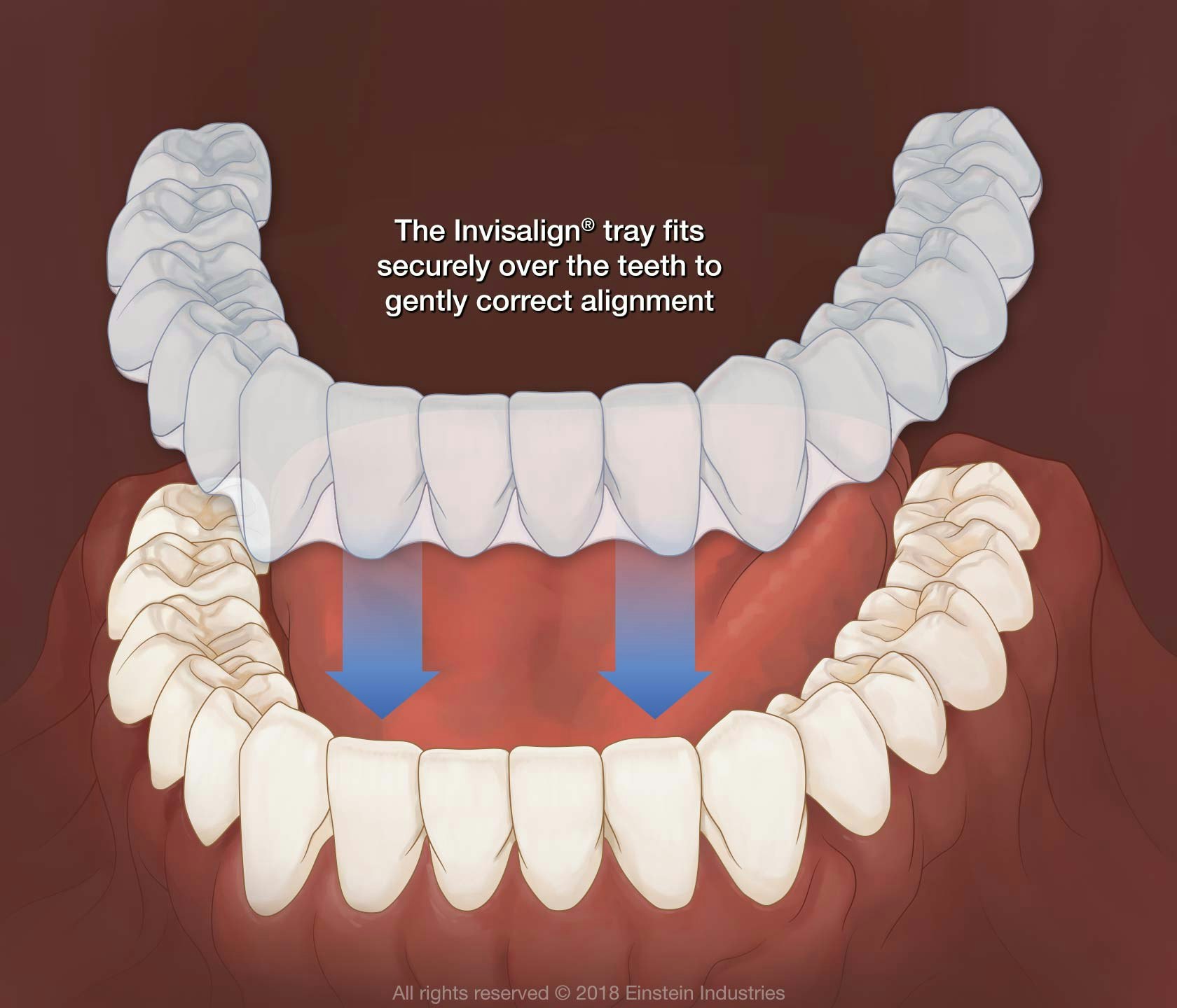 Invisalign tray
