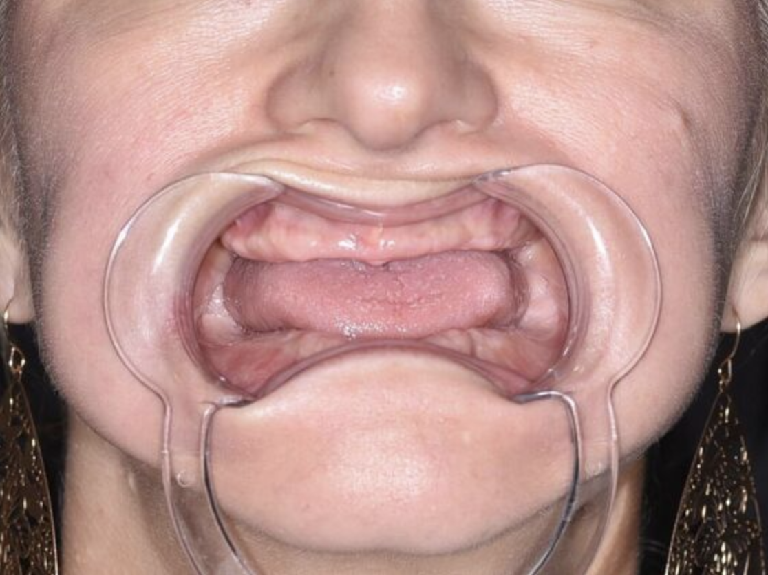 Before All-on-4 treatment with Koyfman Dental