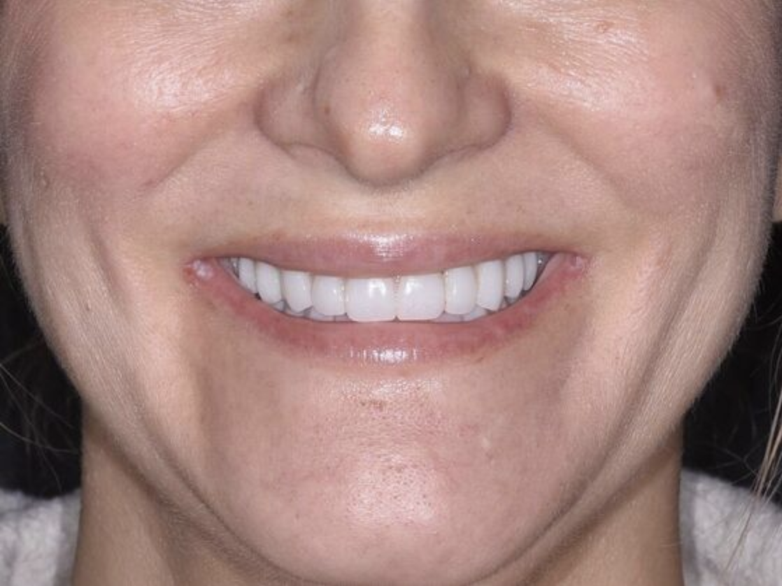 After All-on-4 treatment at our Orlando dental office