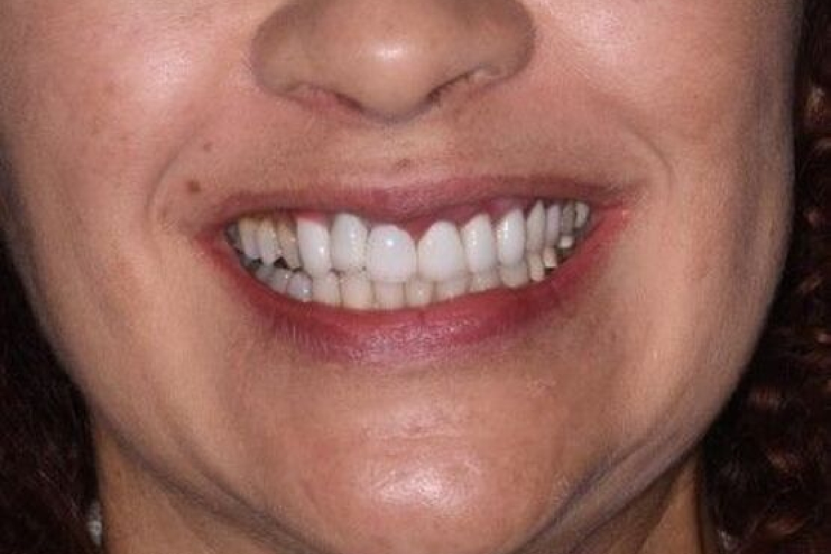 Before a smile makeover in Orlando, FL