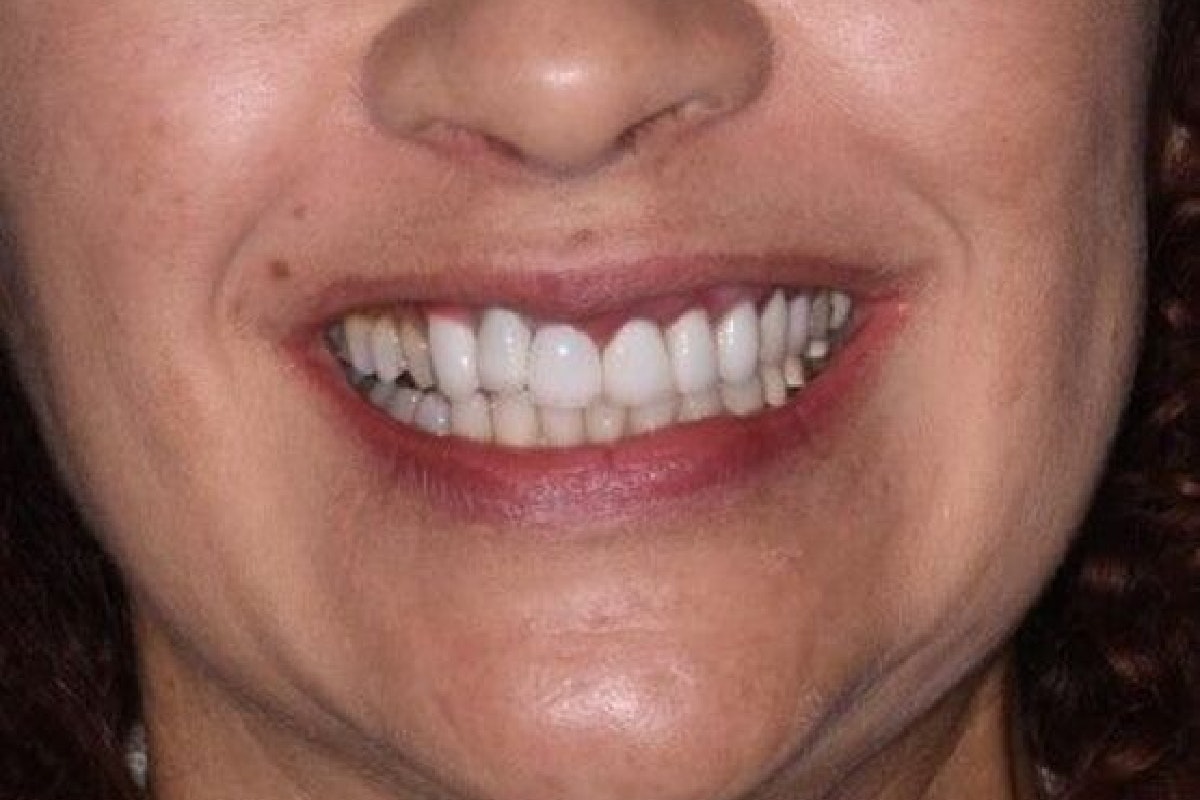 Before a smile makeover in Orlando, FL