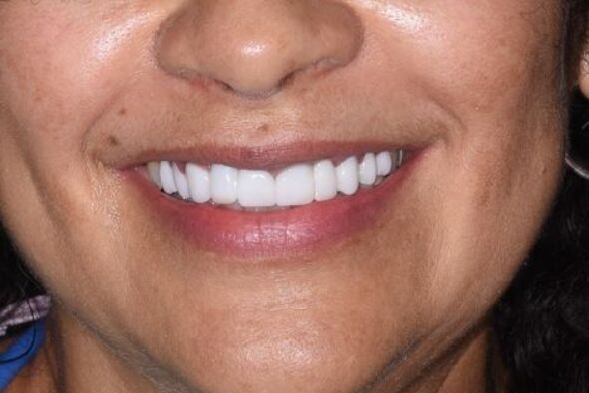 After a cosmetic dentistry smile makeover
