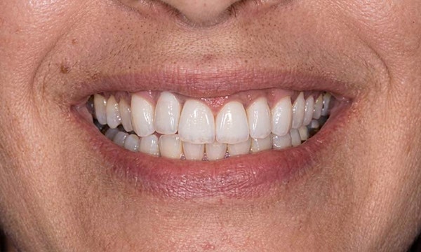 Koyfman Dental patient before smile makeover