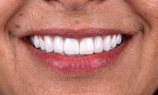 Koyfman Dental patient after smile makeover