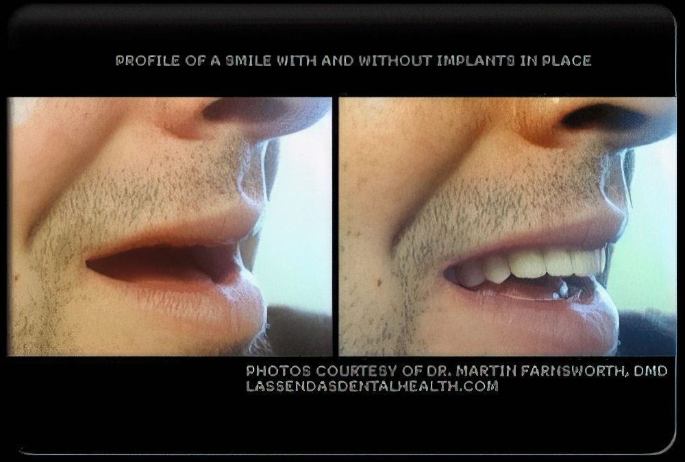 Before and after denture procedure