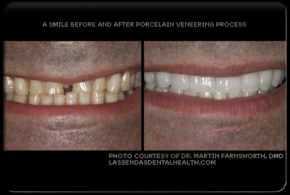 Yellowed uneven gapped teeth before and and white even teeth after veneers procedure