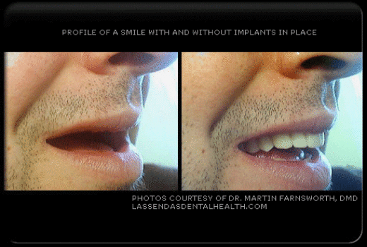 Las Sendas Dental Health patient before and after dental implants