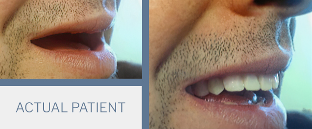 our patient before and after receiving implant-supported dentures