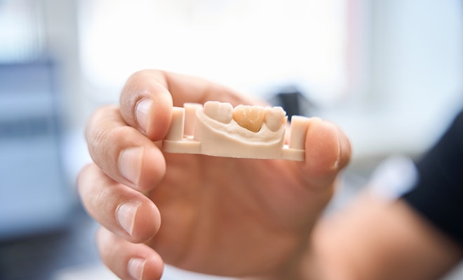 Hand holding up model of dental implant on tooth