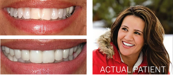 Smiling patient before and after cosmetic dentistry