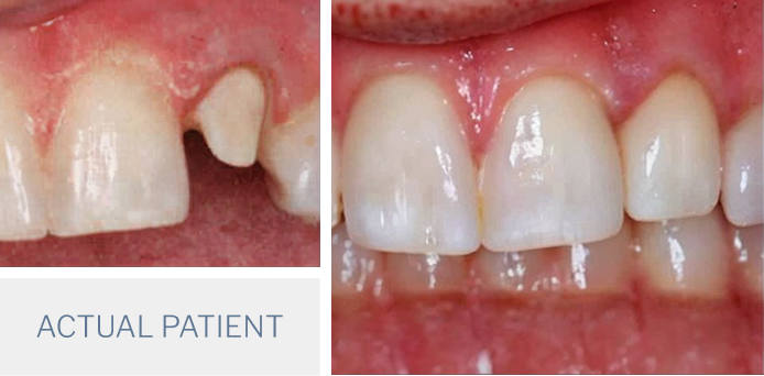 before and after dental crown