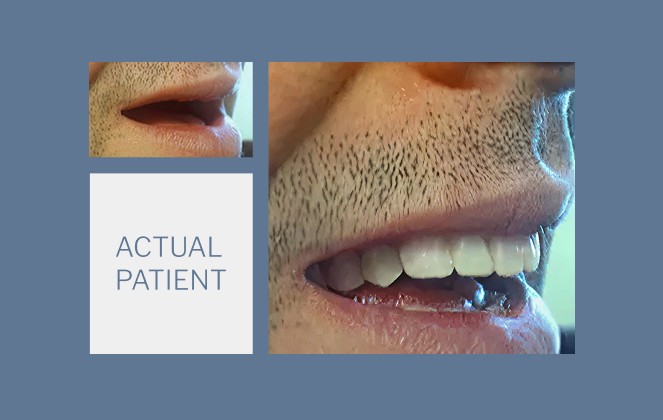 An actual patient before and after oral surgery