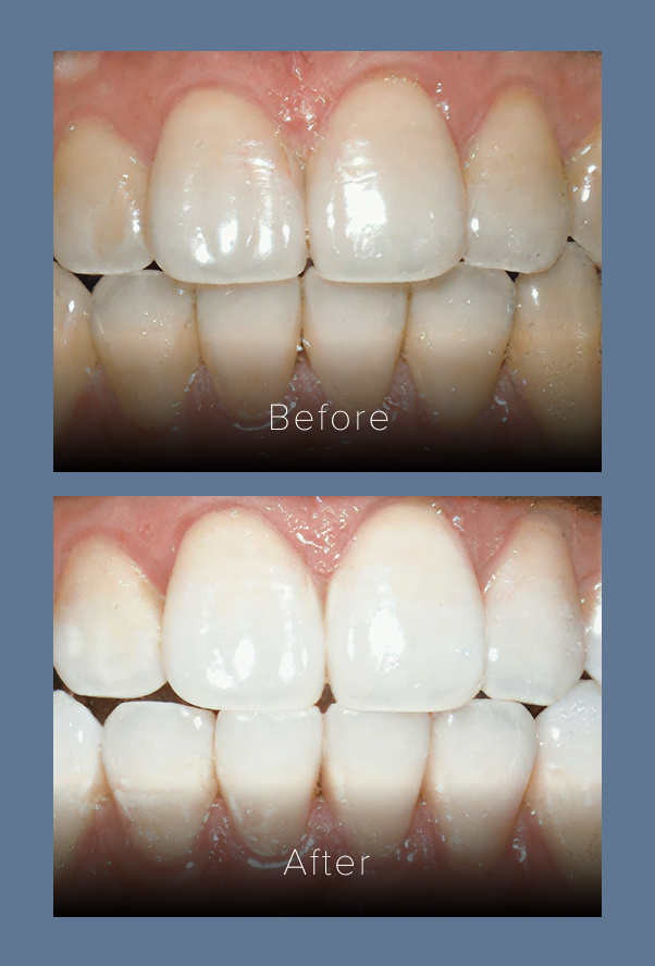 Teeth whitening before and after