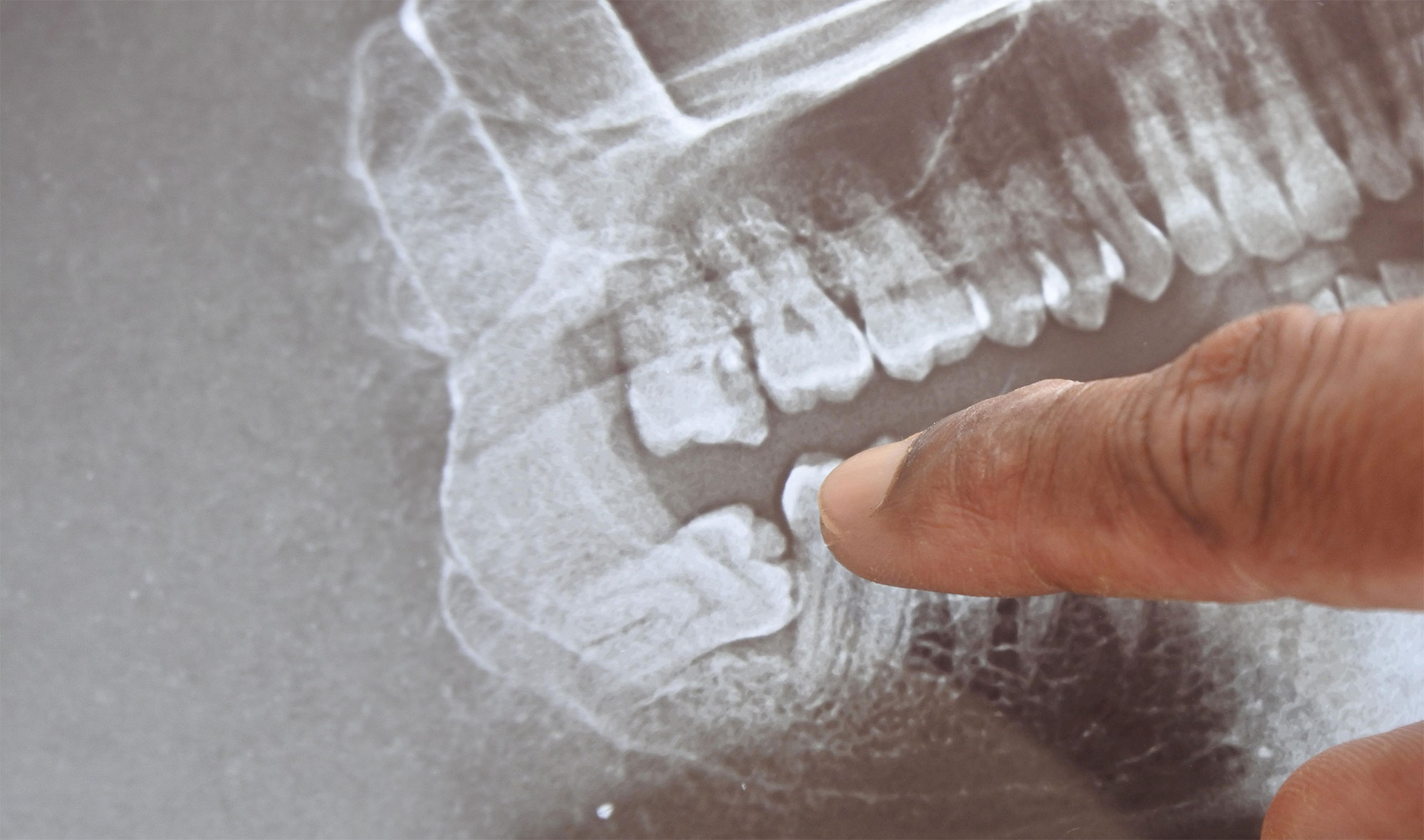 x-ray of a wisdom tooth
