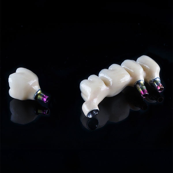 Implant-supported crown and bridge