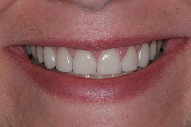 Dr. Helton's patient after veneers