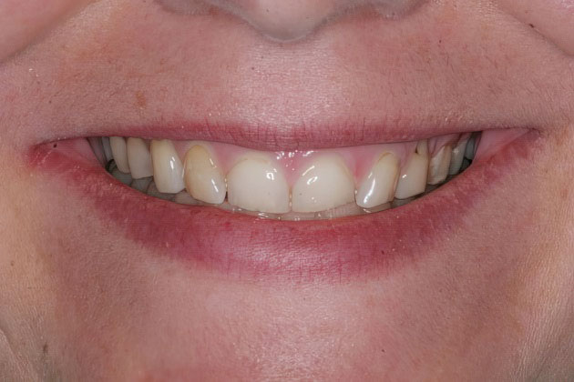 Dr. Helton's patient before veneers