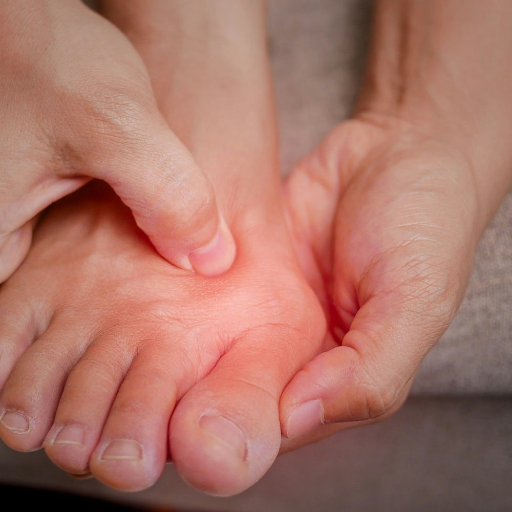 Someone with a painful bunion holding their foot