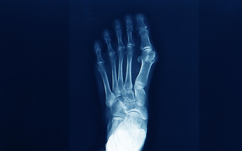 X-ray of deformed foot with bunion