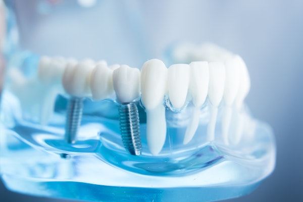 Dental Implant Model