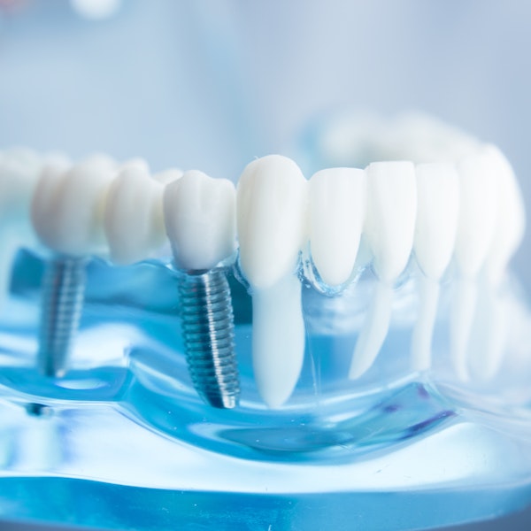 Dental Implant Model