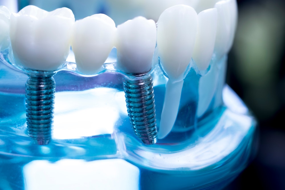 A clear model of dental implants