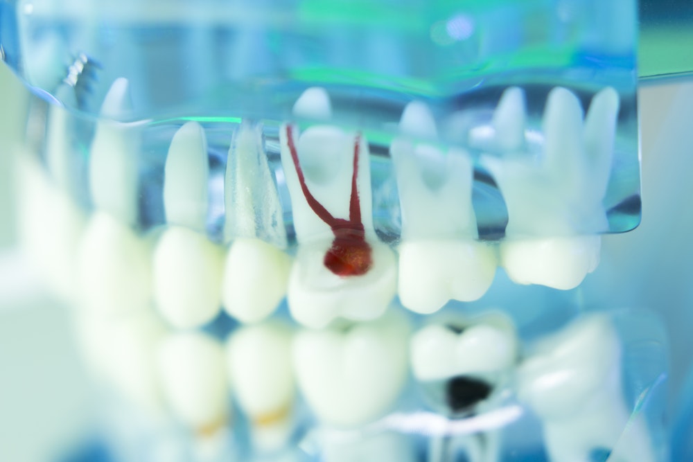 Dental model of root decay