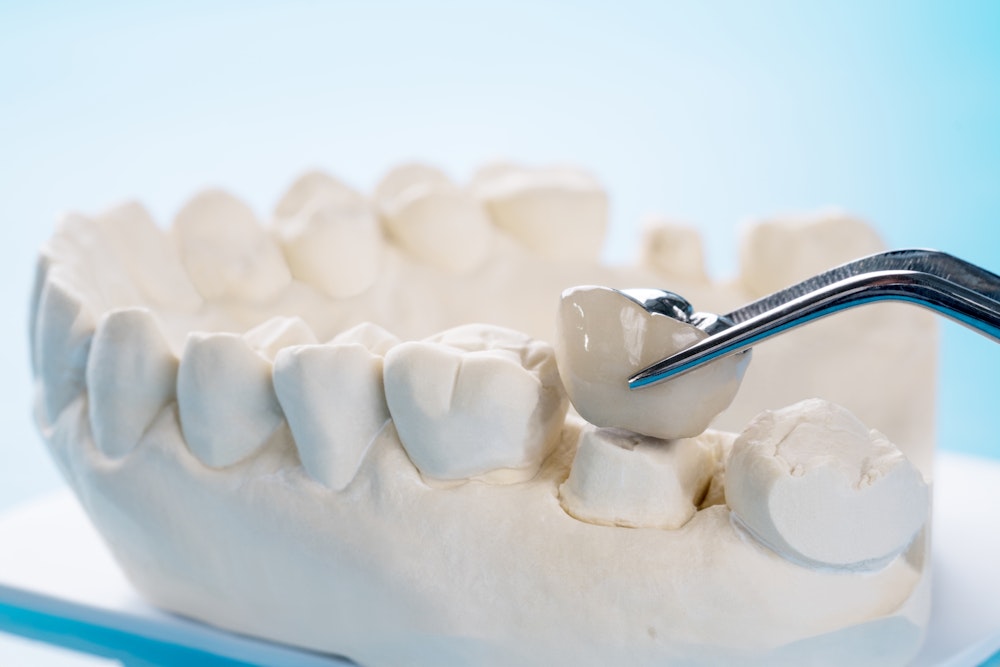 Dental crown being placed on a dental model