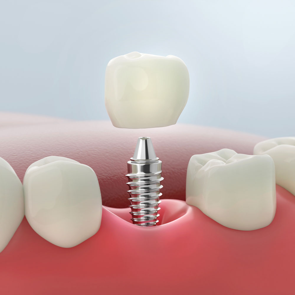 implant-supported crown