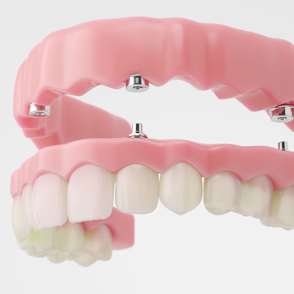 implant-supported dentures
