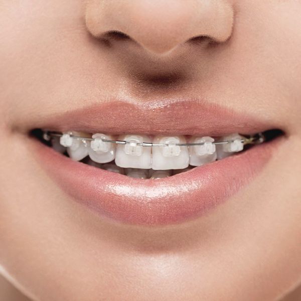 Smile with clear braces